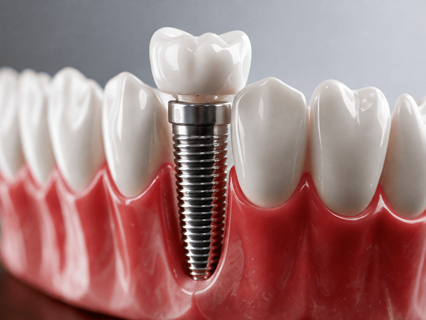 Trattamento odontoiatrico di Chirurgia orale e implantologia